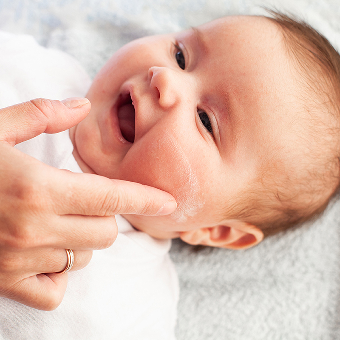 Dermatite Atopica: i primi segnali sulla pelle